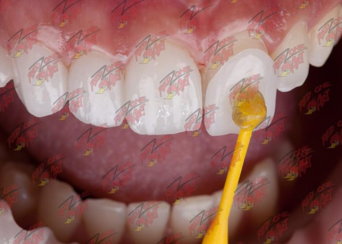 fasete-za-zube-dr-ast-2